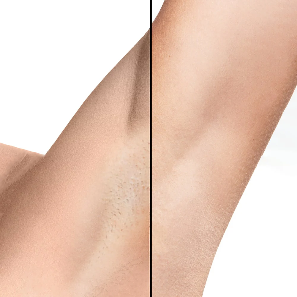 Lumi Épilateur à Lumière Pulsée - Image 9
